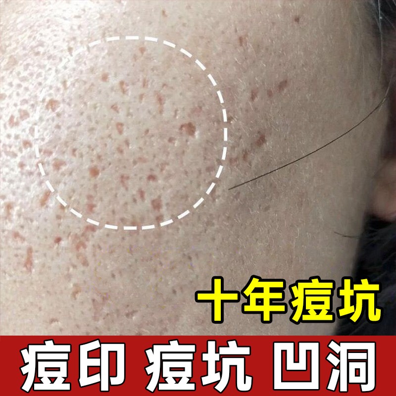 痘印痘坑痘疤膏凹洞填充再生收缩毛孔淡化去痘坑修复膏红肿凝胶丘疹