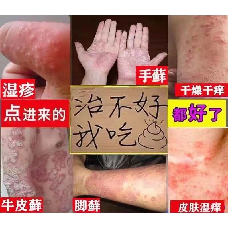 脱皮干裂脚藓手癣真菌感染汗状手上起小水泡专用软 水泡专用软