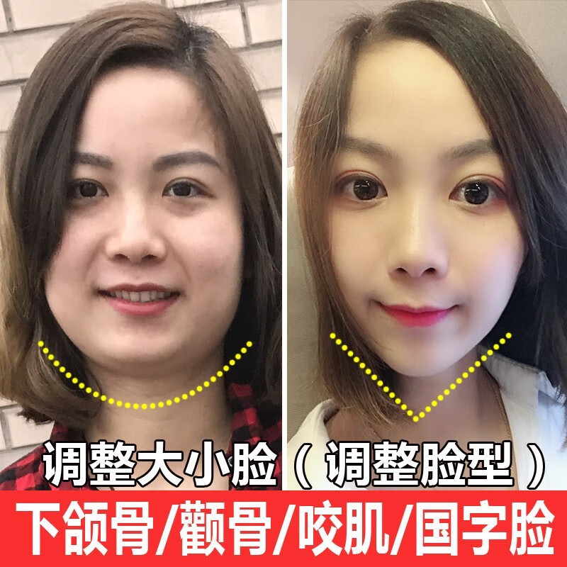 大小脸矫正 国字脸去咬肌消除大小精华水消颧骨内推下颌缩小突出矫正