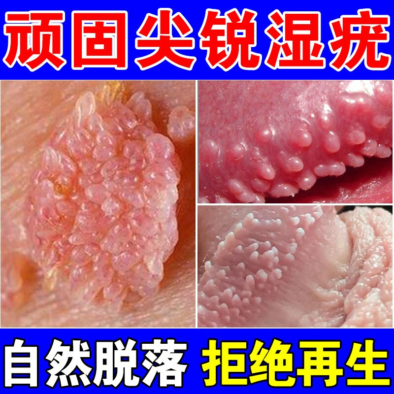 尖锐湿疣专用男女性私处病毒感染丝状扁平疣寻常疣肛周湿 单盒轻度装
