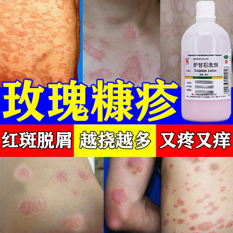 炉甘石洗剂 1盒装【治玫瑰糠疹药】