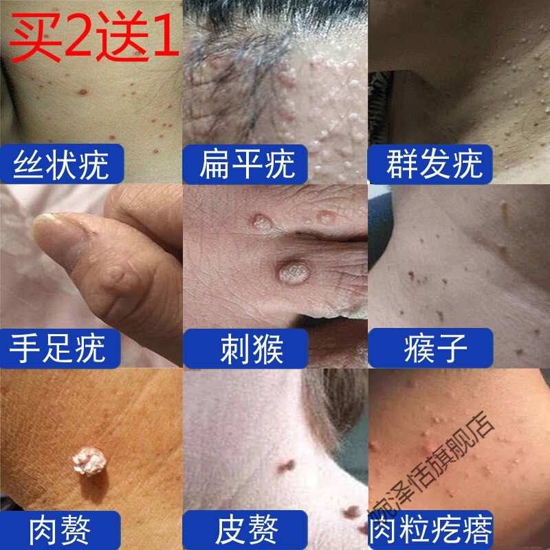 瘊猴子去除膏 丝状尤疣立净克优疣液脖子颈部皮赘私处