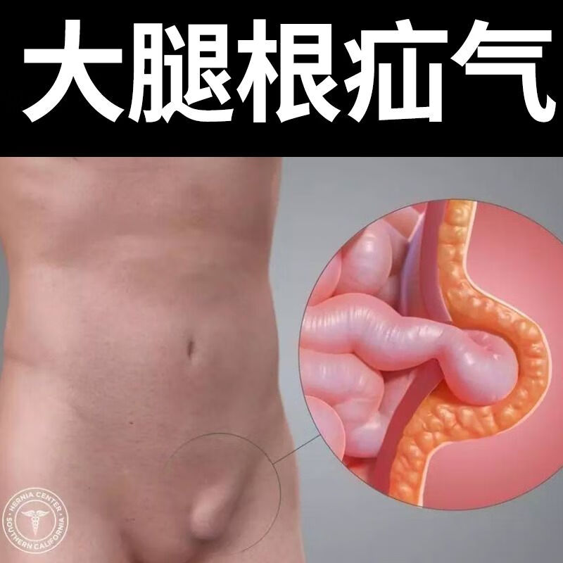 疝气鼓包肿块腹股沟斜疝气腹外疝用pl 疝气 大腿根鼓包 按压疼痛(7盒)