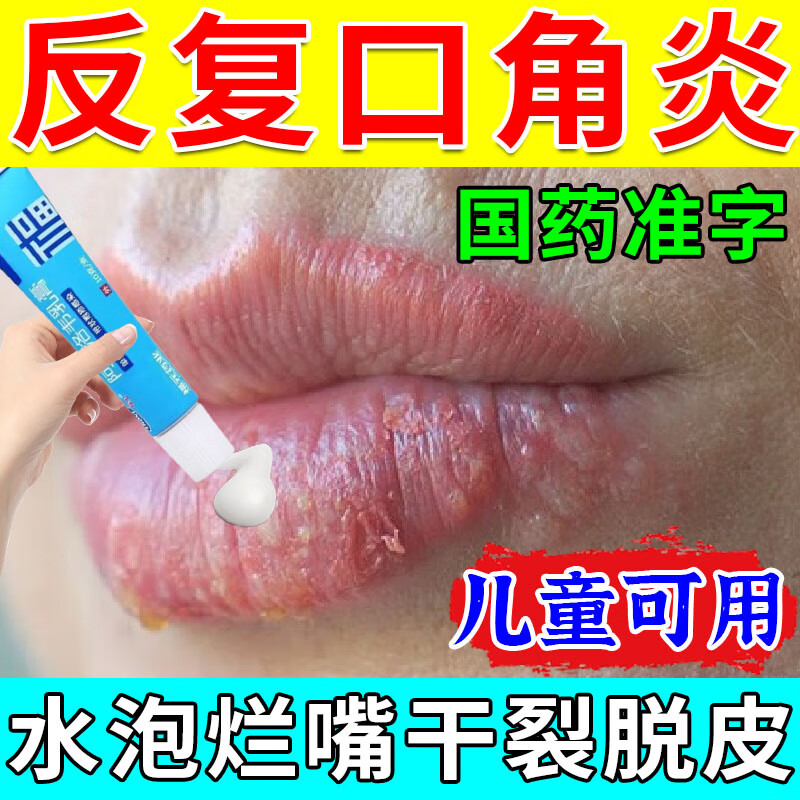 口角炎烂嘴角药膏】成人儿童通用 疱疹感染嘴唇疱疹特疼口角炎效药
