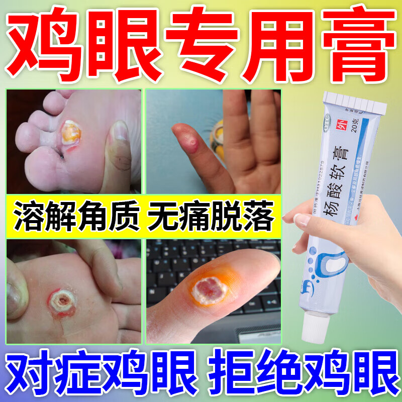 治疗局部角质增生形成的鸡眼肉刺药膏无痛脱落脚掌手部鸡眼疼痛难忍
