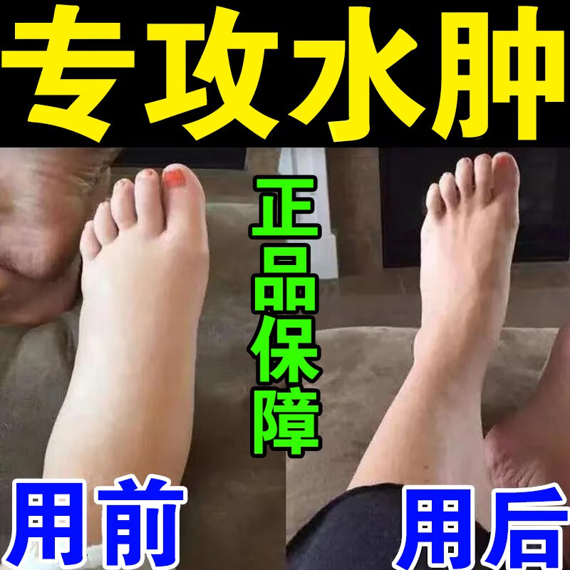 剂水肿消除水肿药贴老人脚肿小腿下肢水肿浮肿消肿 1盒