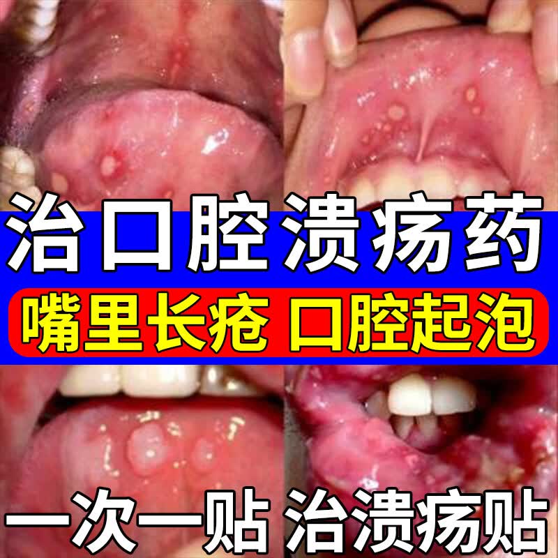 口腔溃疡专用药贴 甲硝唑口腔粘贴片治口舌生疮嘴巴里面疼痛舌头起泡