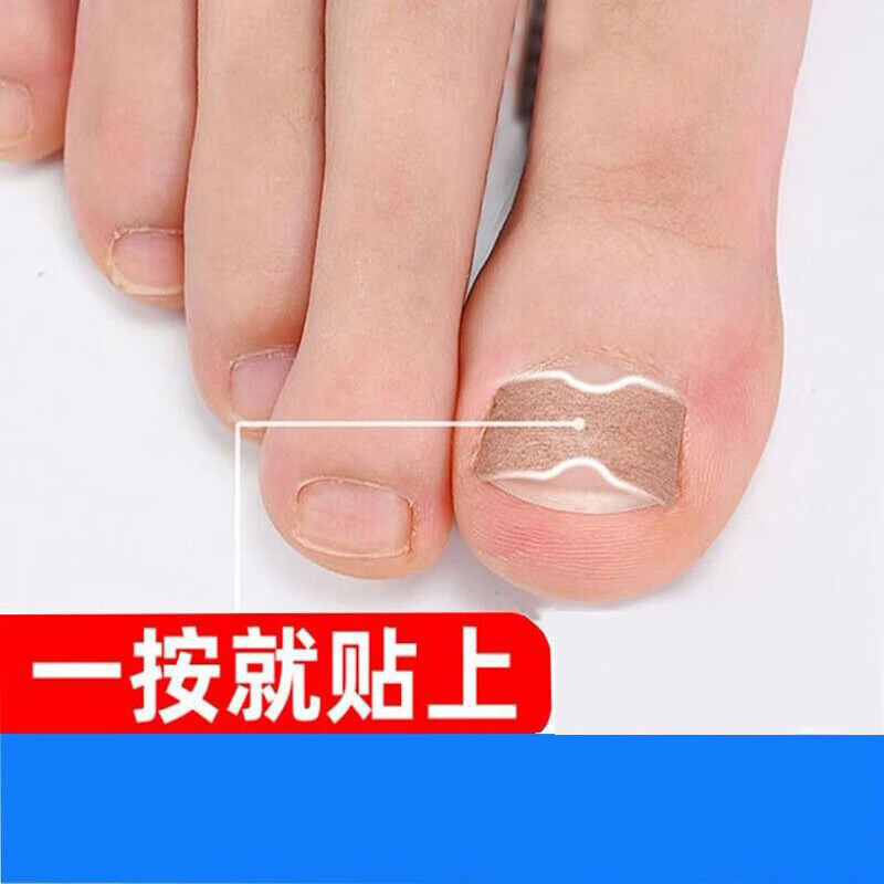 汁寒磐 脚趾甲沟炎矫正器正甲贴贴片嵌甲神器指甲长到肉里面正甲 [20