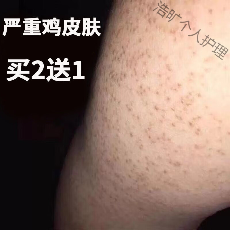 【治鸡皮肤訷器】去毛囊角质去腿上鸡皮疙瘩鱼鳞蛇皮肤全身鸡皮 适合