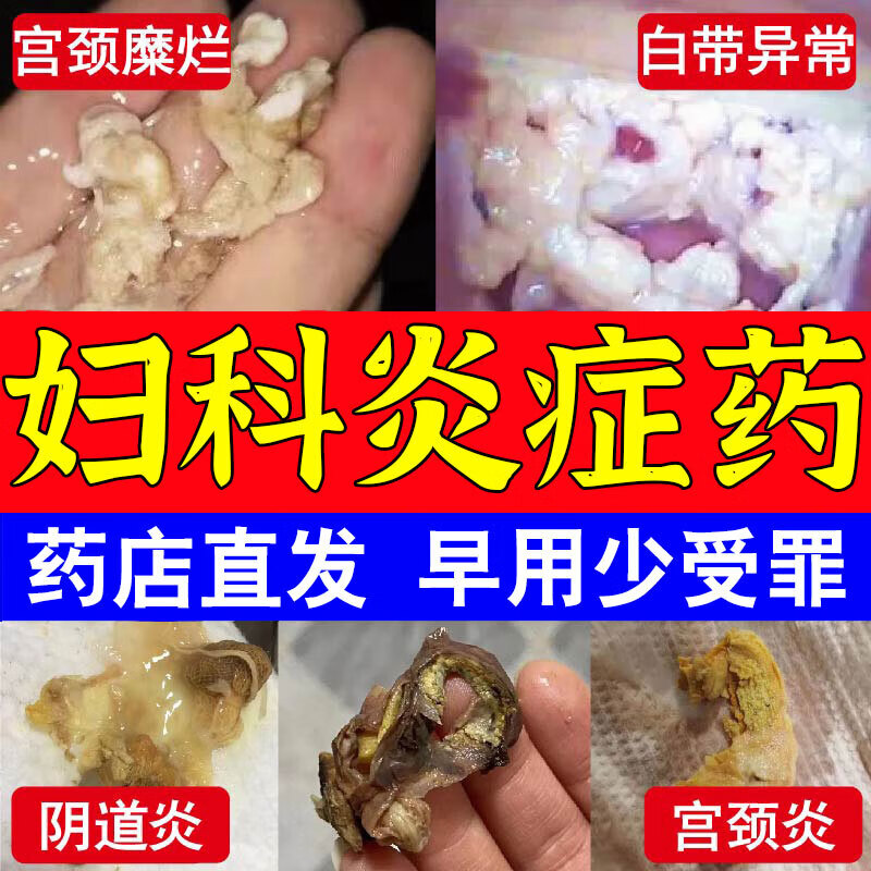 宫颈糜烂妇科用药二度三度宫颈糜烂的药妇科消炎药 治多种妇科炎症