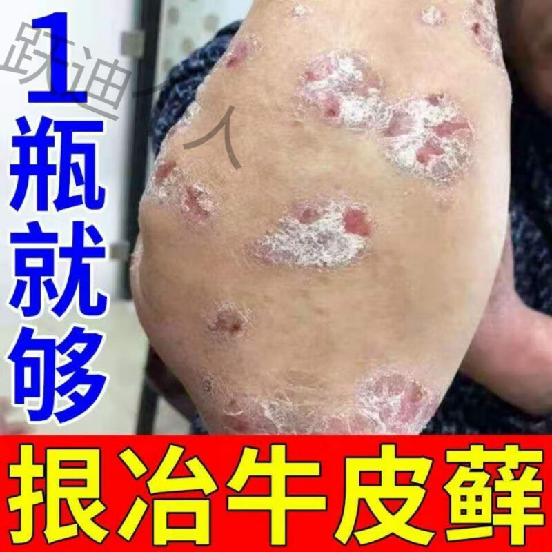 【一抹藓消】皮肤l廯全身tx牛皮l癣汗l疱l疹手上小水泡手痒脱皮干裂