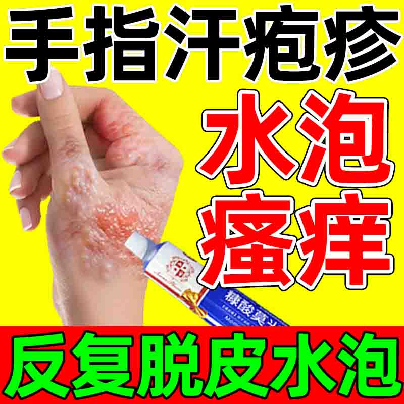 汗疱疹药膏 手上起小水泡手指真菌感染 手痒手指钻心痒皮肤瘙痒皮炎