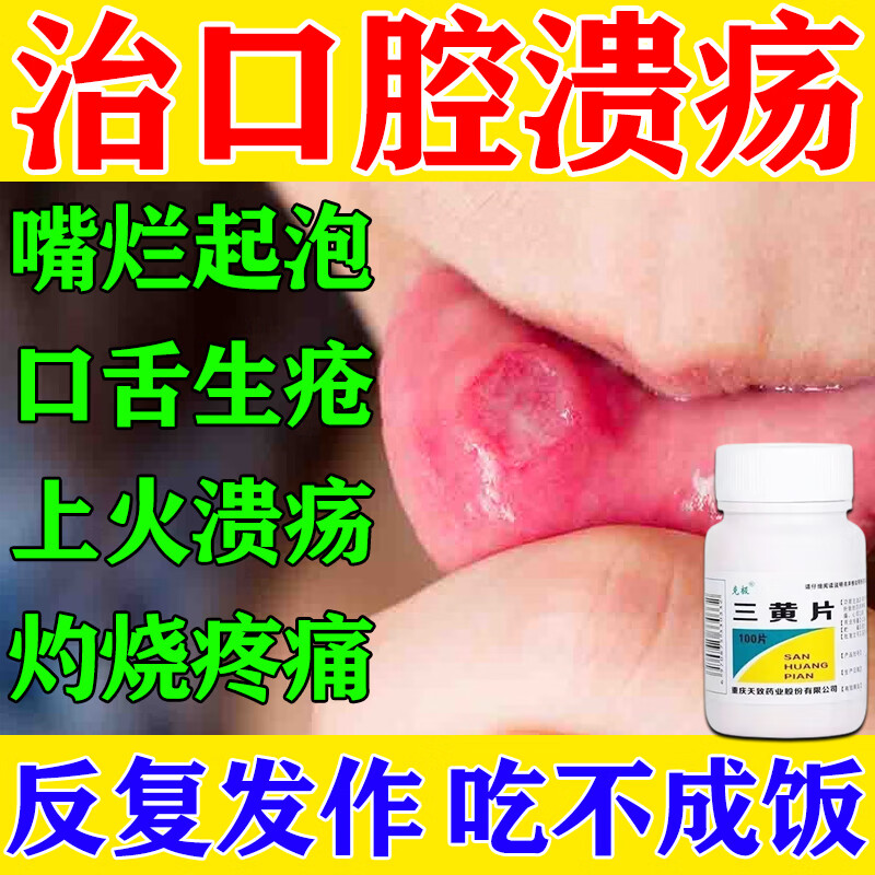 口腔溃疡吃什么药】治口腔溃疡嘴烂起泡上火溃疡反复发作口舌生疮吃不