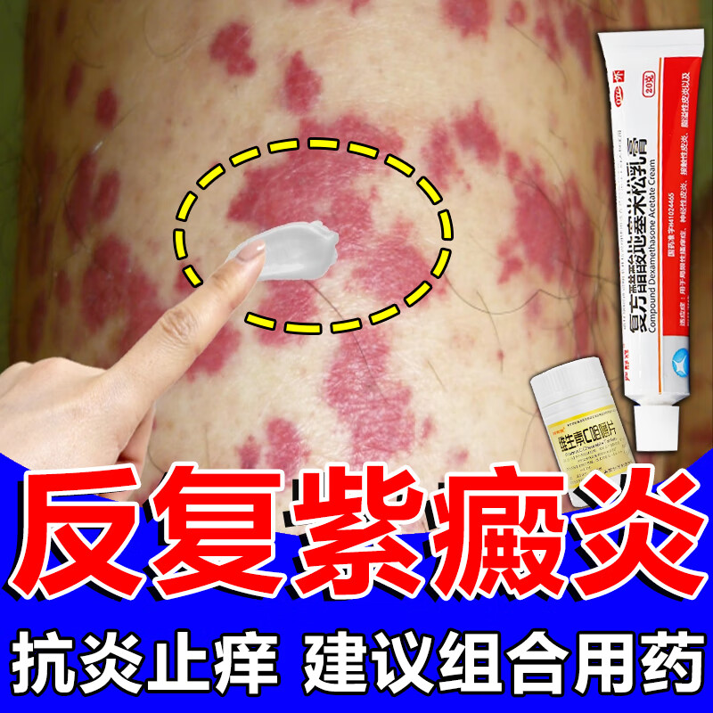 复方醋酸地塞米松乳膏 紫癜性皮炎成人皮肤过敏紫癜性消除红色瘀斑血
