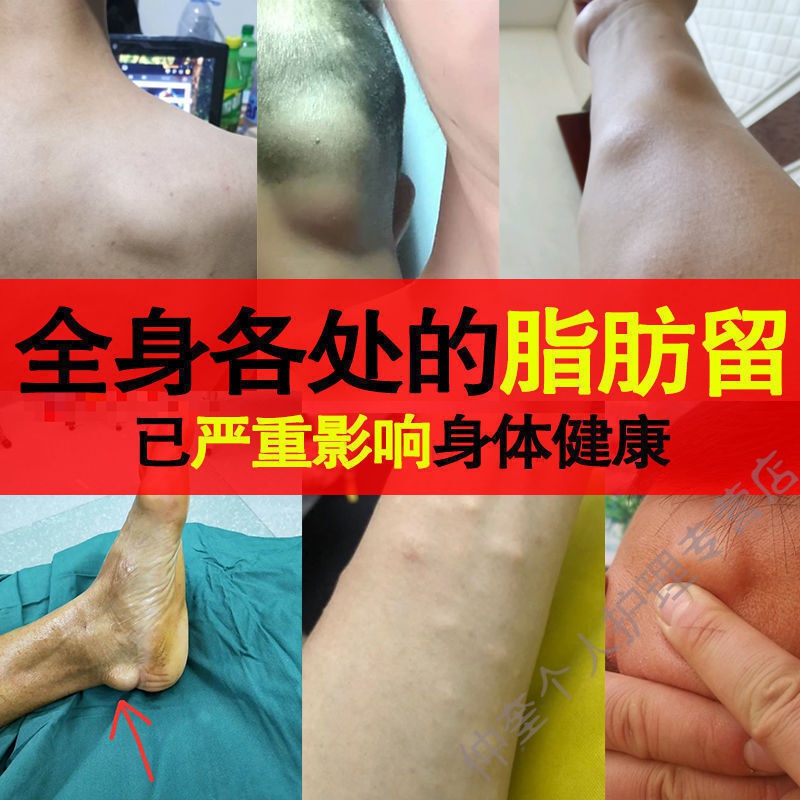 脂肪瘤肖除膏去皮下单发性多发性脂肪瘤硬块肿块凸起脂肪瘤背部单发性