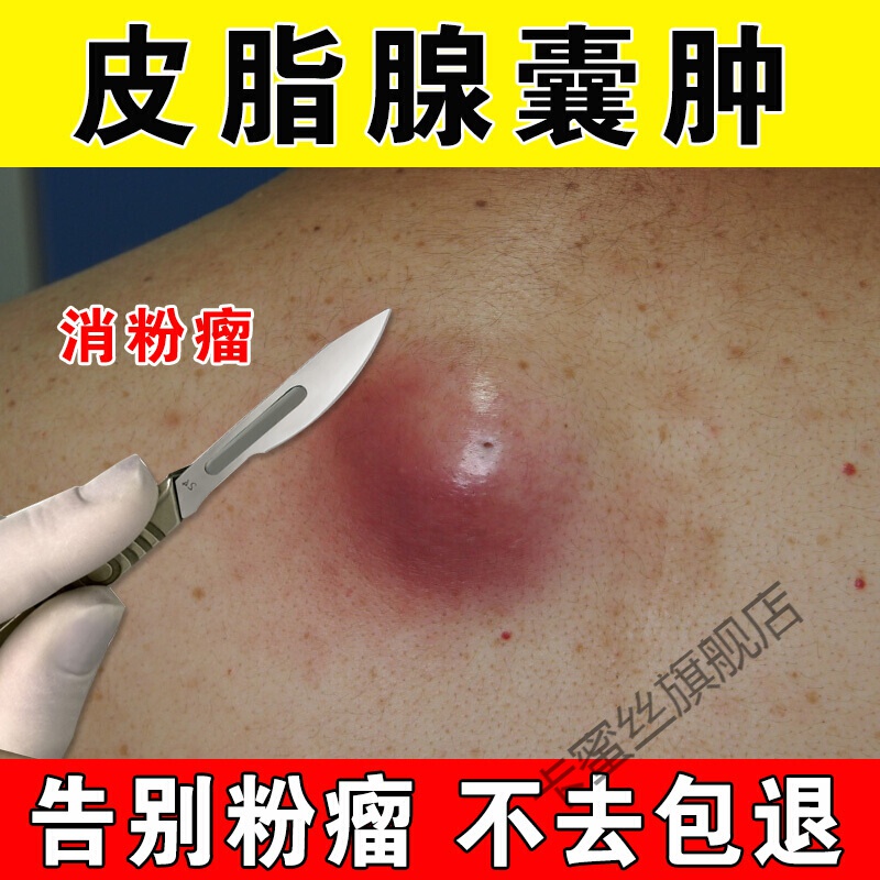 粉瘤贴皮脂腺囊肿膏粉瘤贴痘痘疏通巴氏腺前庭大腺结节消贴全身包块
