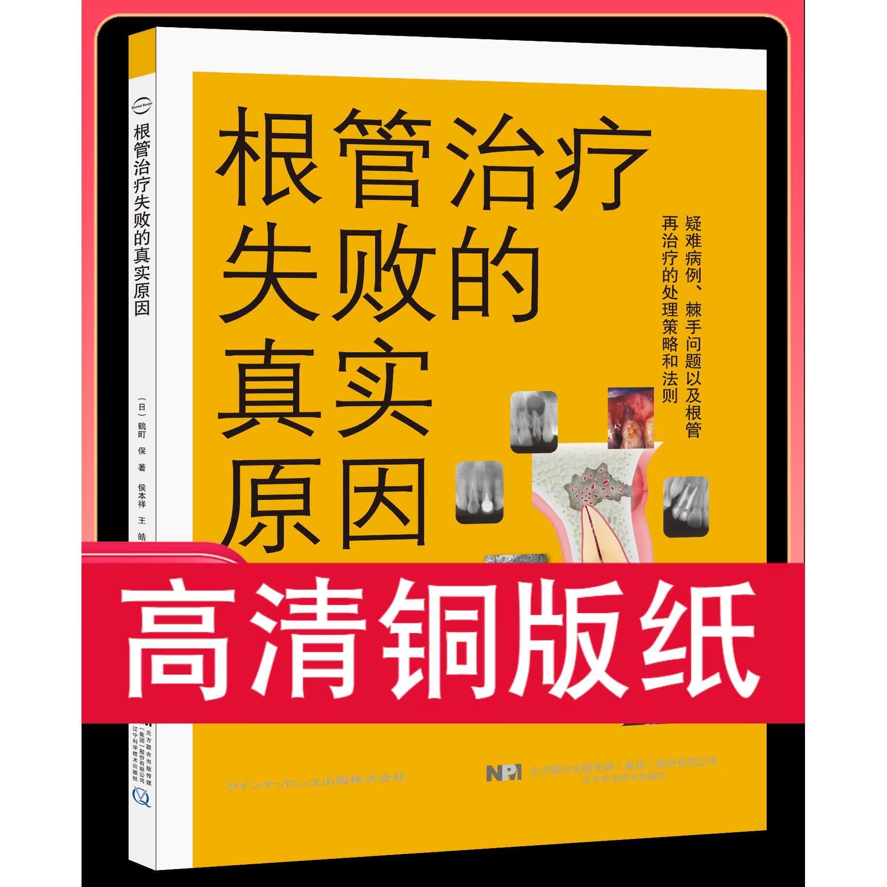 根管治疗失败的真实原因 铜版纸
