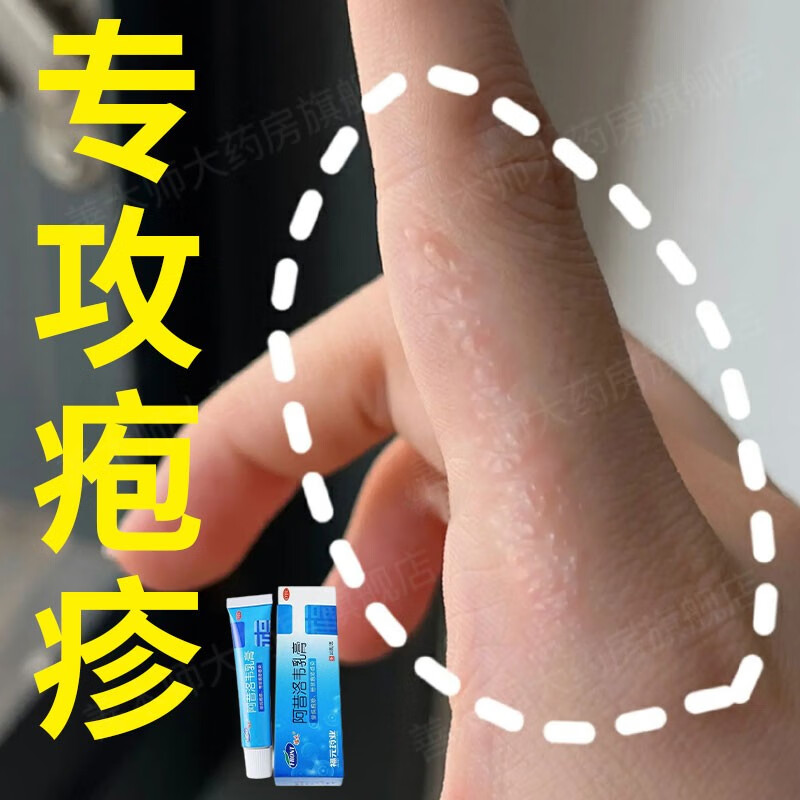 手上起小水泡用什么药 手部单纯疱疹水痘很痒特别痒专用药 抗疱疹病毒