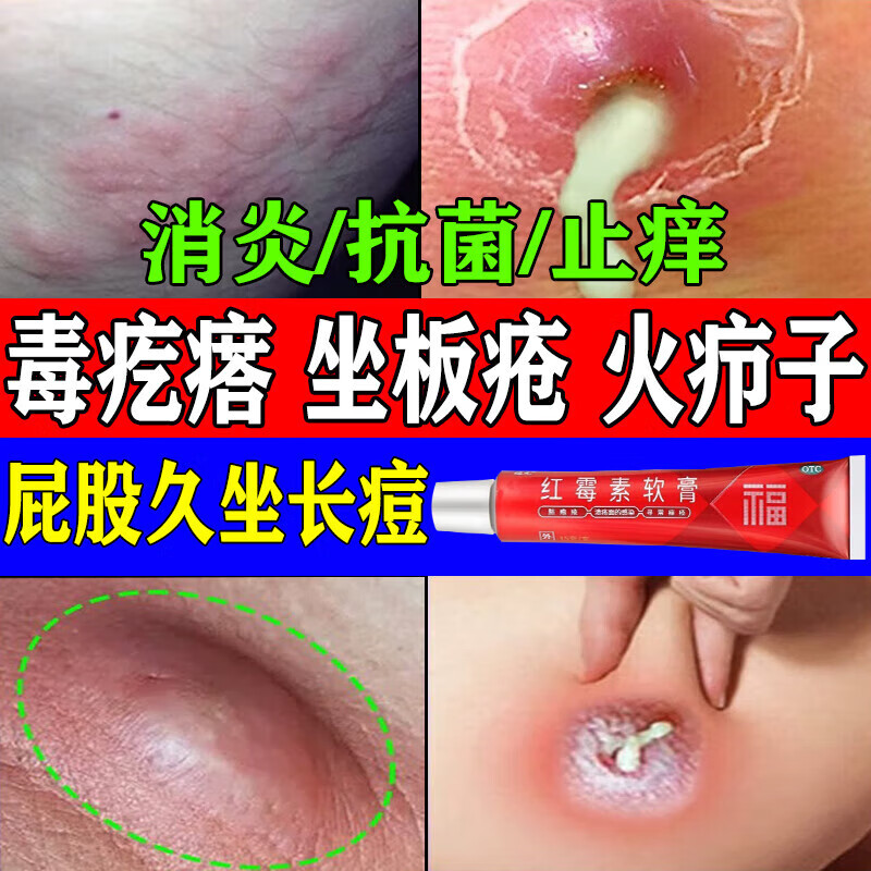 坐板疮药膏 屁股瘙痒久坐长痘痘 屁股长疙瘩脓包火疖子毒疙瘩大腿内侧