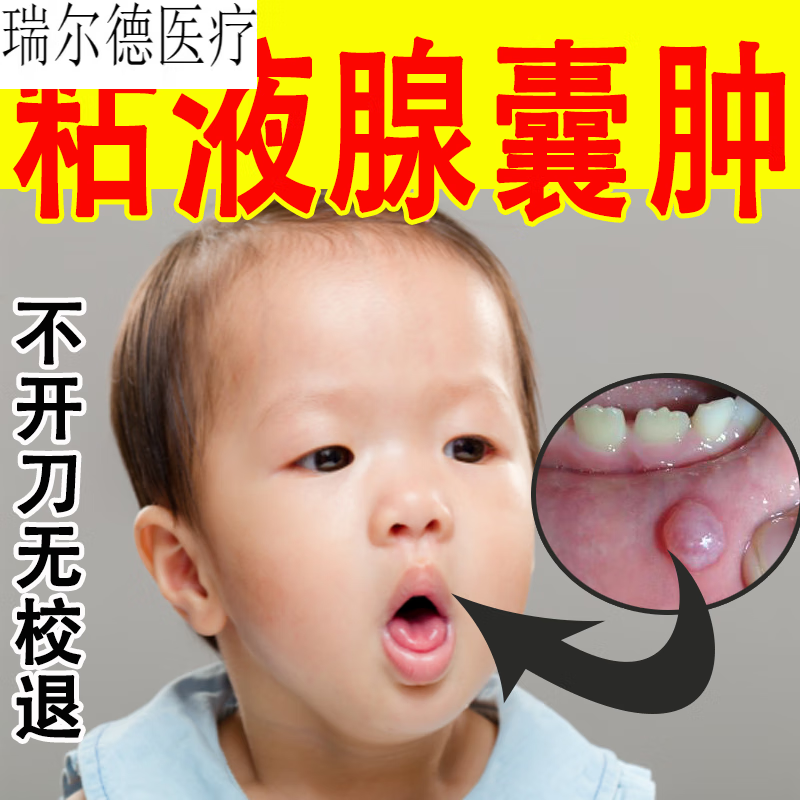 粘液腺囊肿舌根淋巴滤泡增生扁桃体发炎肥大肿痛慢性咽炎口腔水泡