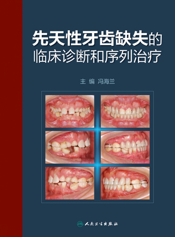 先天性牙齿缺失的临床诊断和序列治疗