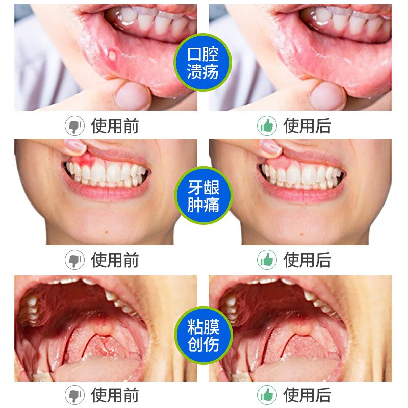 喷剂口腔溃疡缓痛x1牙周广雅起泡牙龈质量怎么样值不值得买？亲测解析实际情况