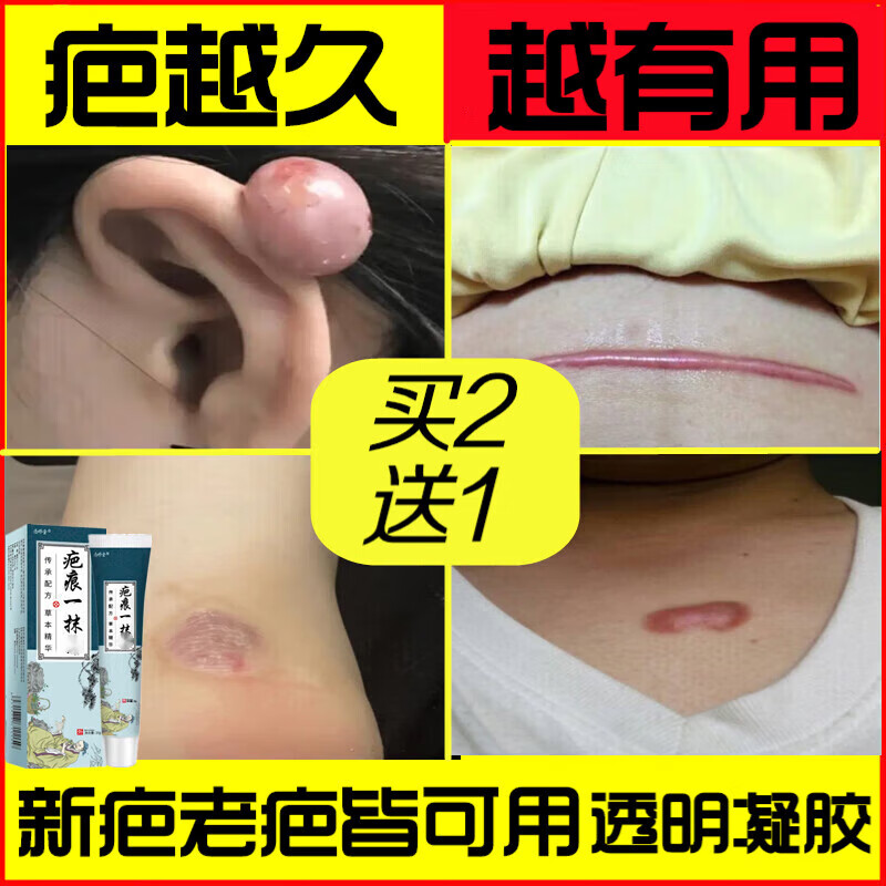kdk疤痕灵增生疤痕疙瘩凸起软化胸前瘢痕体质伤疤手术疤痕灵修复