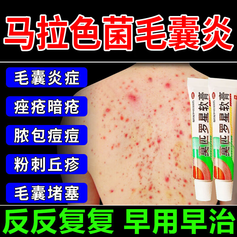 莫匹罗星软膏马拉色菌毛囊炎抗真菌药膏前胸后背头部颈部长小痘丘疹