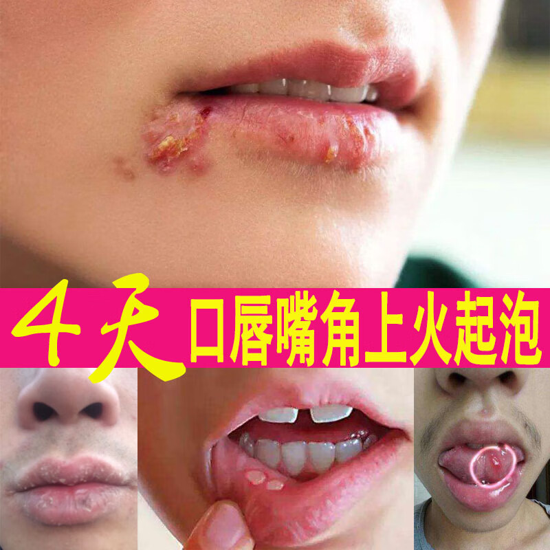 珍珠金银花粉剂口腔上火嘴里嘴唇嘴角溃口疮舌头起水泡嘴烂起泡疡