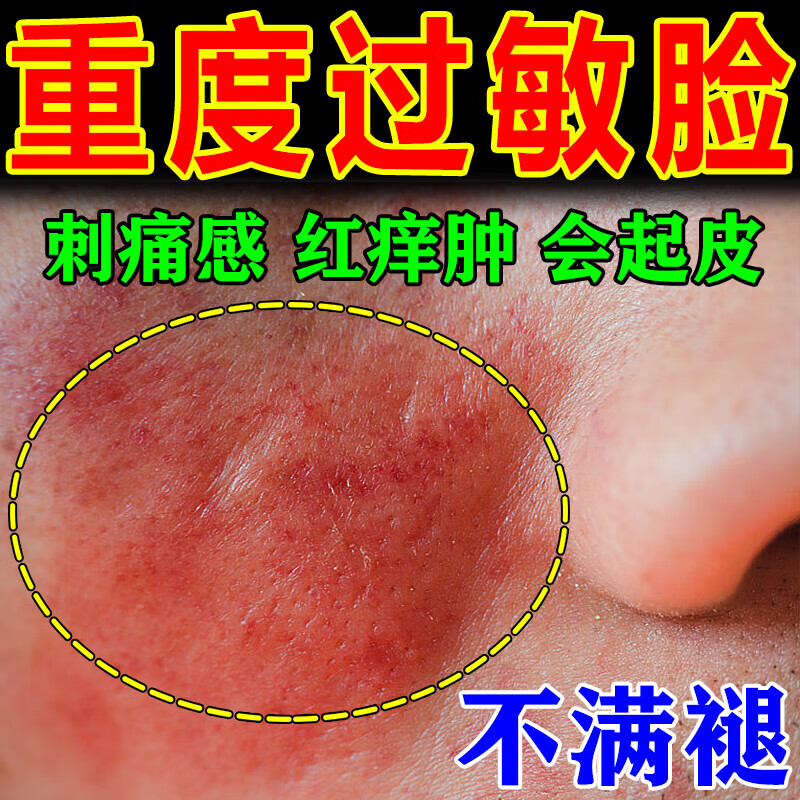 脸过敏皮肤修复膏 脸部红痒干燥蜕皮起疙瘩长癣红疹止i痒换季脸脸过敏