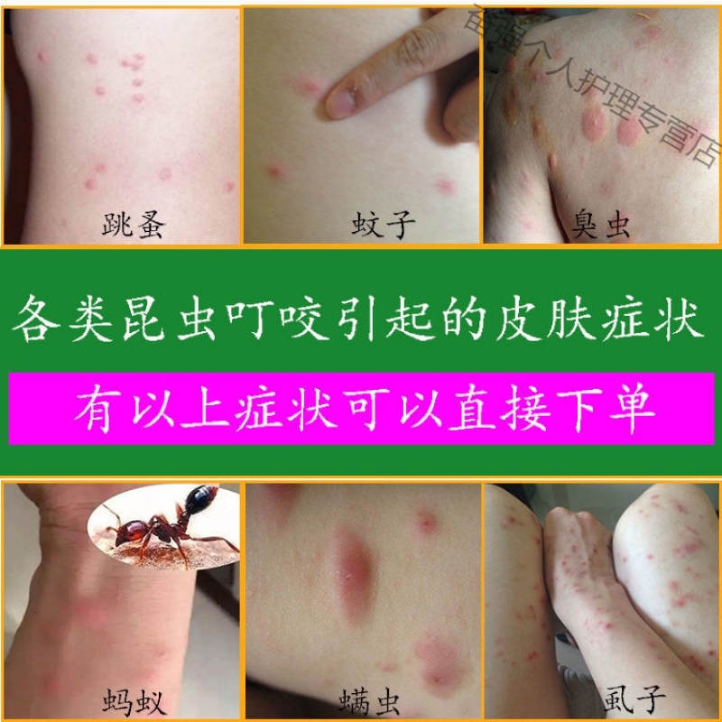 百草止痒蚊虫叮咬止痒膏儿童成人跳蚤咬皮肤瘙痒止痒王一抹灵膏箹