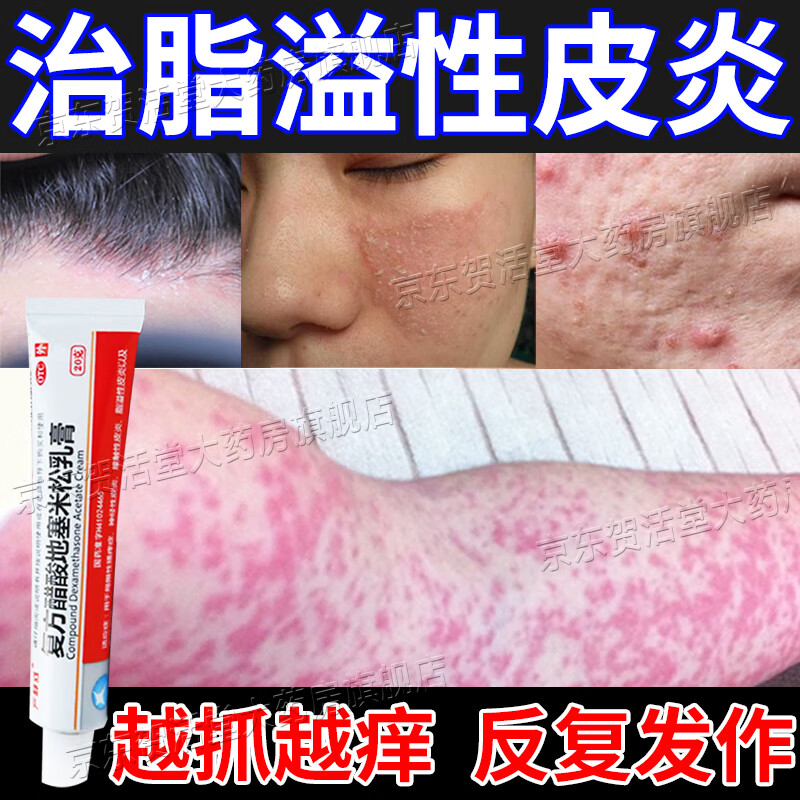 溢脂性皮炎药膏下巴面部鼻子头皮红肿硬块油腻硬痘痘瘙痒止痒毛囊炎