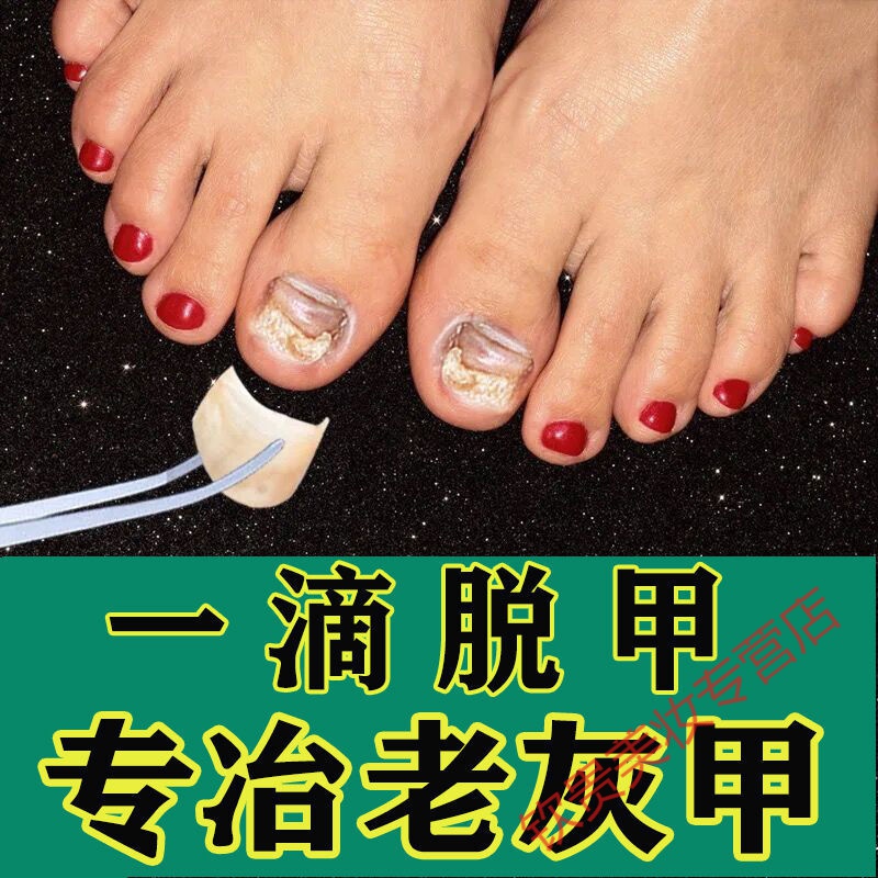 久木堂甲郎中坏甲变好甲灰指甲专用液草本精油护甲液增厚变色 【轻度