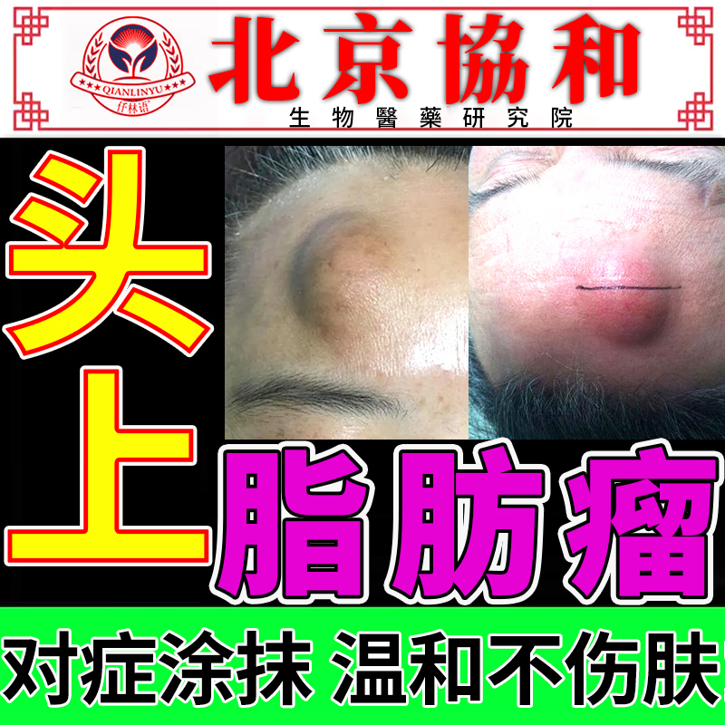 头部额头脂肪瘤专用粉瘤肉留去i除膏神器消i除硬块皮下囊肿可搭配特效