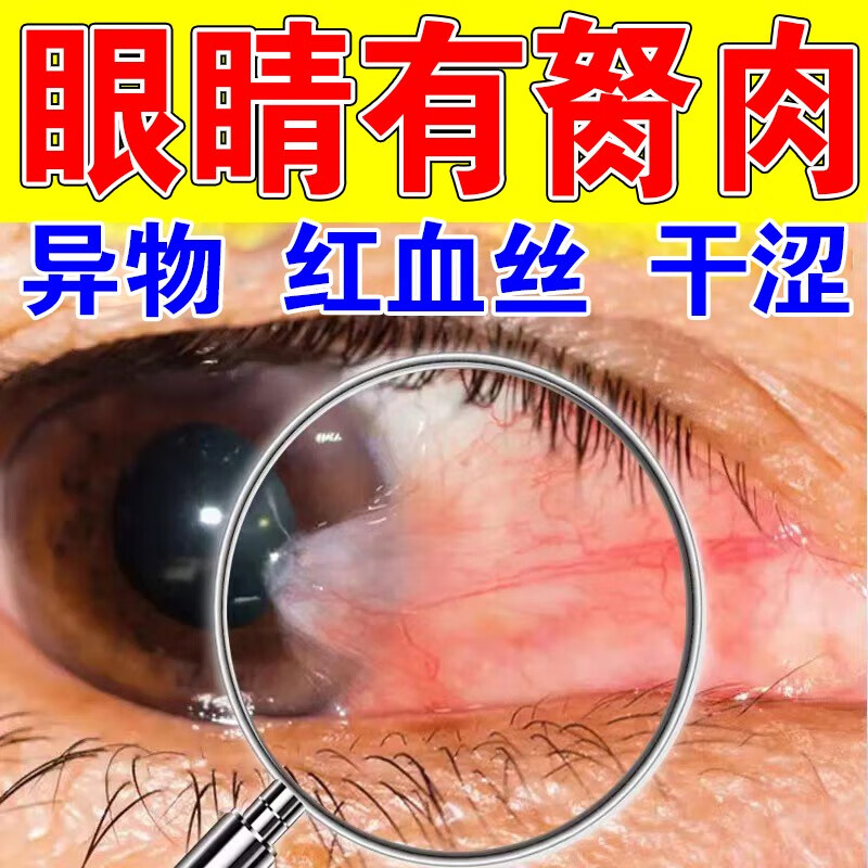 眼睛胬肉翼状胬肉眼水红血丝视力模糊眼干浑浊发痒有异物感润 单盒装