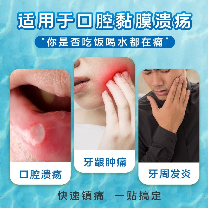 意可贴 醋酸地塞米松口腔贴片 用于非感染性口腔溃疡黏膜溃烂破损清热