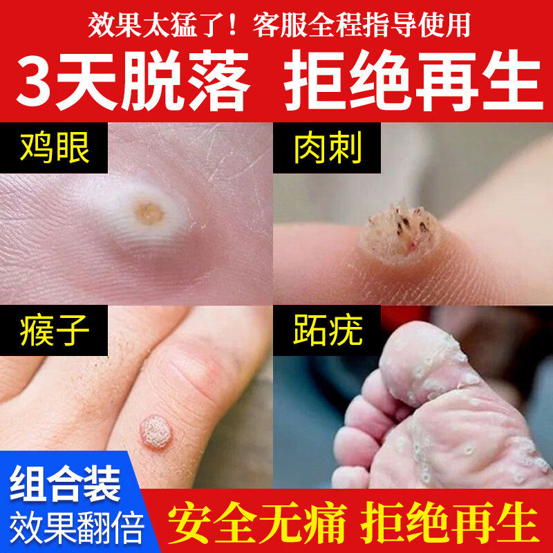 鸡眼贴鸡眼膏脚趾跖疣瘊子去除手部肉刺脚鸡眼药鸡尤平 1盒