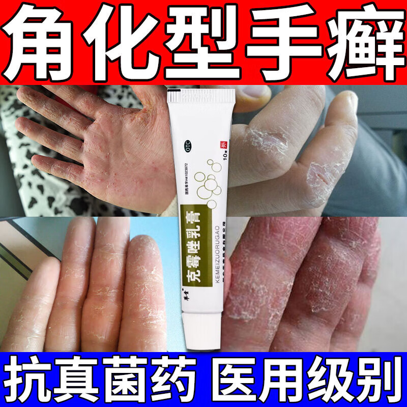 手指关手节癣顽固性手癣手掌增厚鳞屑粗糙脱皮干裂皮肤瘙痒皮炎湿疹