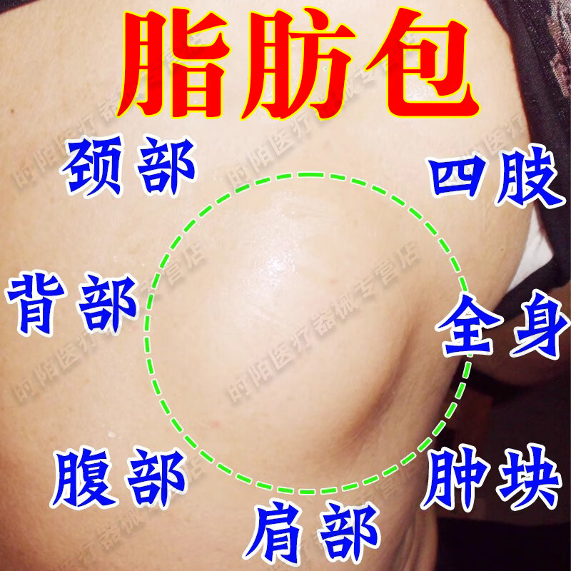 脂肪瘤专用非药脂肪康去除膏脂肪瘤专用3天消专消36种皮下多发性去除