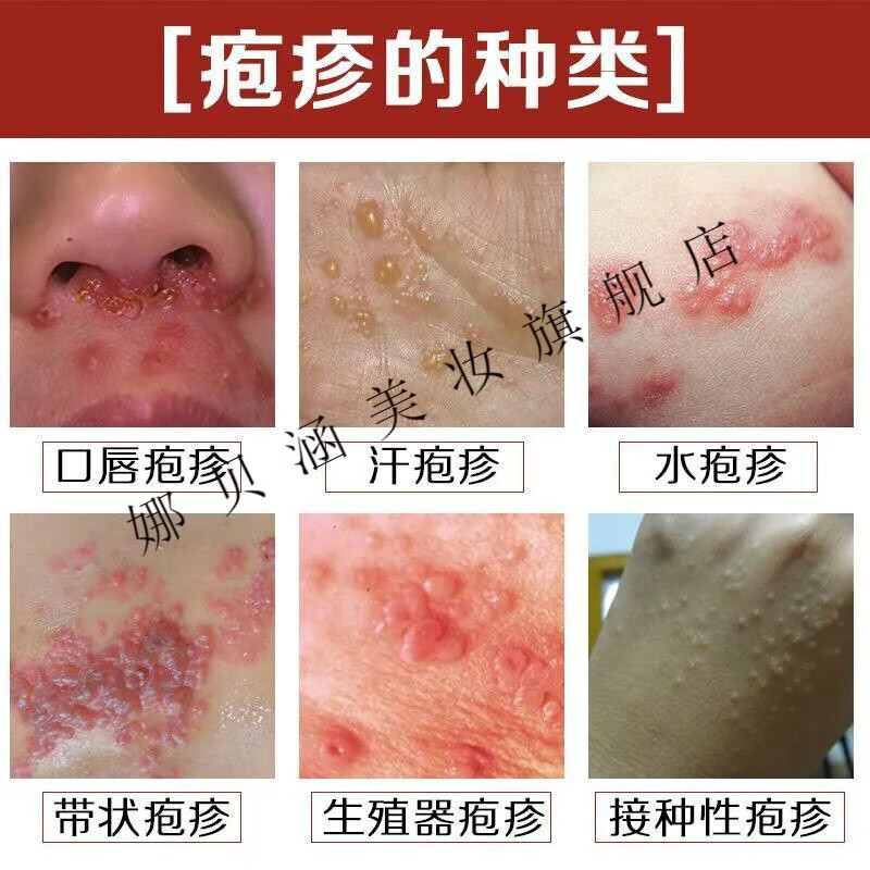 多汗起鸡皮疙瘩(出虚汗起鸡皮疙瘩) 多汗起鸡皮疙瘩(出虚汗起鸡皮疙瘩)