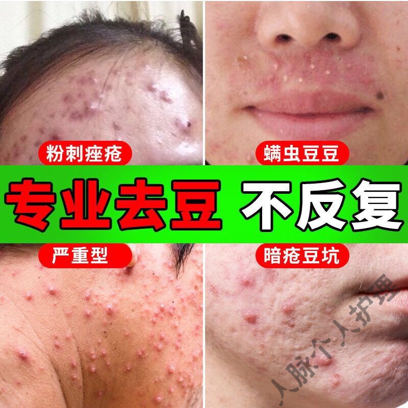 祛螨霜祛痘淡印祛痘神器淡化痘印痘痘闭口亮肤除螨祛痘闭口粉刺黑头痤