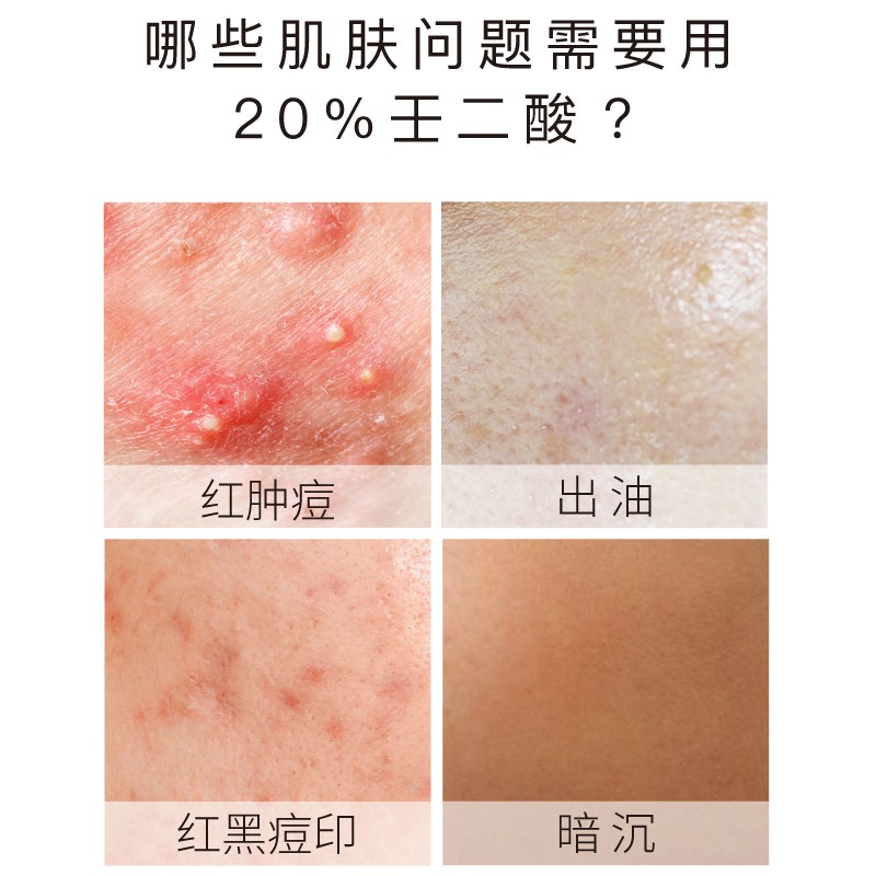 John Jeff20%壬二酸乳霜杜鹃花酸改善痘痘痘印油性皮肤男女护肤情人节礼物 20%壬二酸（改善痘肌、淡化痘印）15g 乳霜
