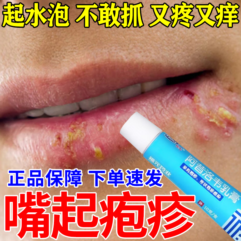 口唇嘴唇疱疹上火痒药疱疹后遗症神经痛外用嘴角溃烂口角炎烂嘴角软i
