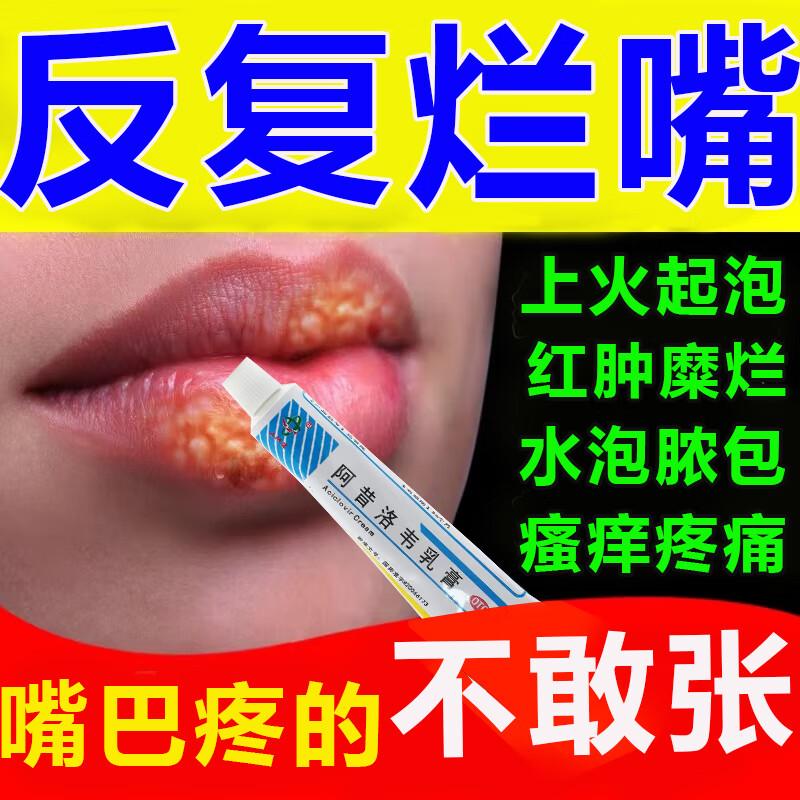 嘴唇疱疹口角炎烂嘴角药膏 嘴巴上火四周瘙痒起泡溃烂治疱疹水泡湿疹