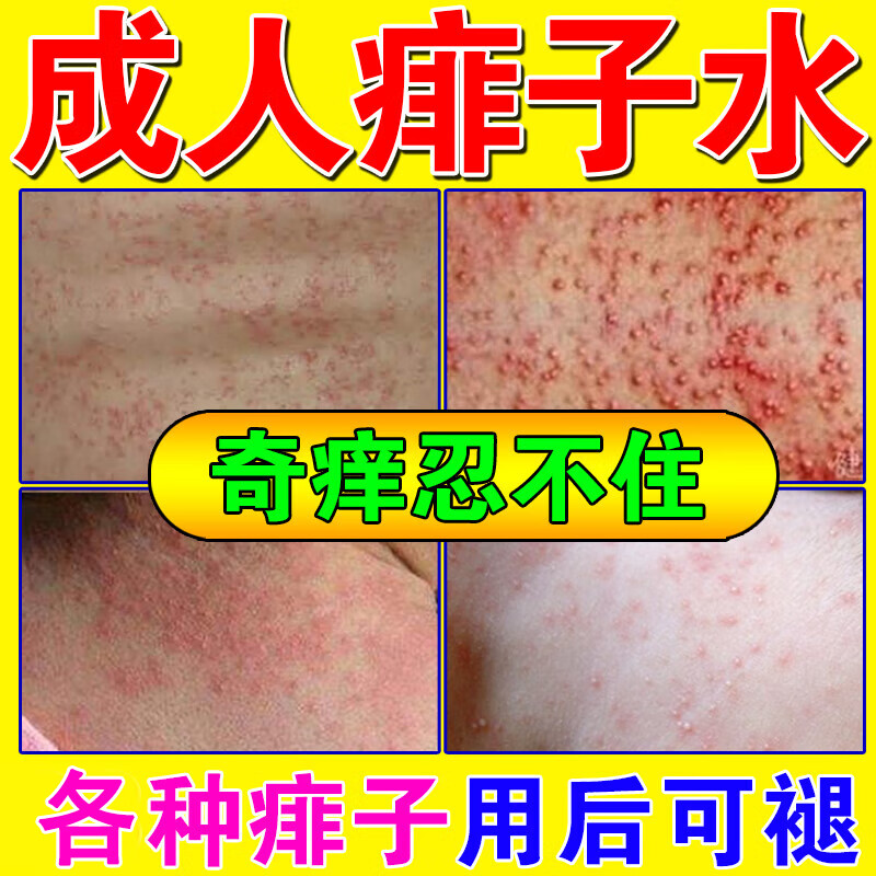 热痱水痱子止痒水去成人痱子喷雾液大人成人去湿疹私处阴妻潮湿祛痱除