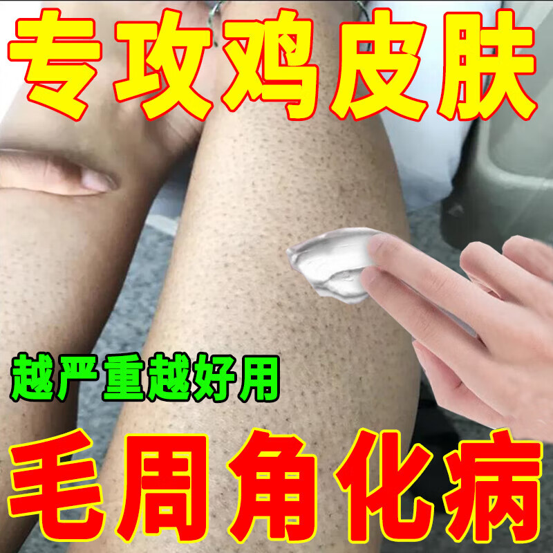 skayz祛除鸡皮肤疙瘩毛囊角化角质大腿毛周角化症手臂脸部去除鸡皮肤