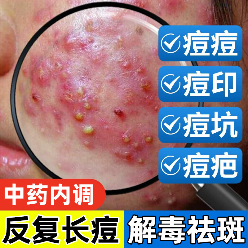 治痘痘的药 脸上去痘痘的药青春痘内服中药痘印红肿硬块痘痘消炎额头