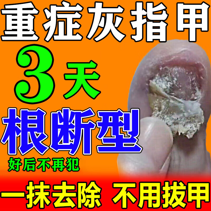 灰指甲特傚效药指甲真菌感染脱甲坏甲脚指甲增厚去除艮治正药 1盒试用