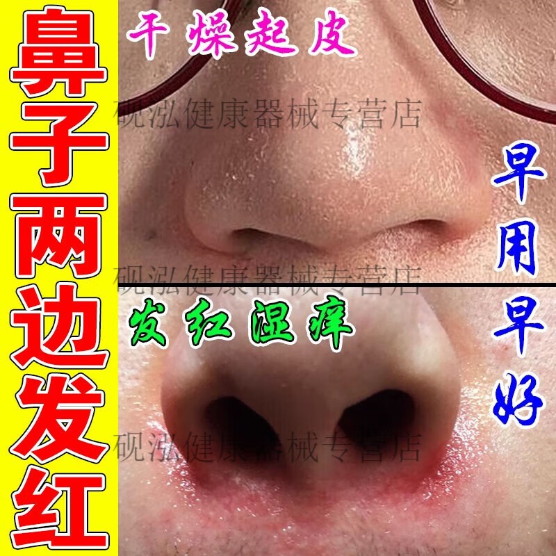 鼻子两侧发红脱皮鼻翼两边泛红干燥起皮掉皮酒糟鼻红鼻头 轻度发红 盒