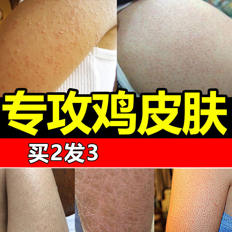 nhfouyou毛周角化症肤疙瘩毛囊炎手臂腿部痘痘毛孔堵塞疏通专用 塞 塞